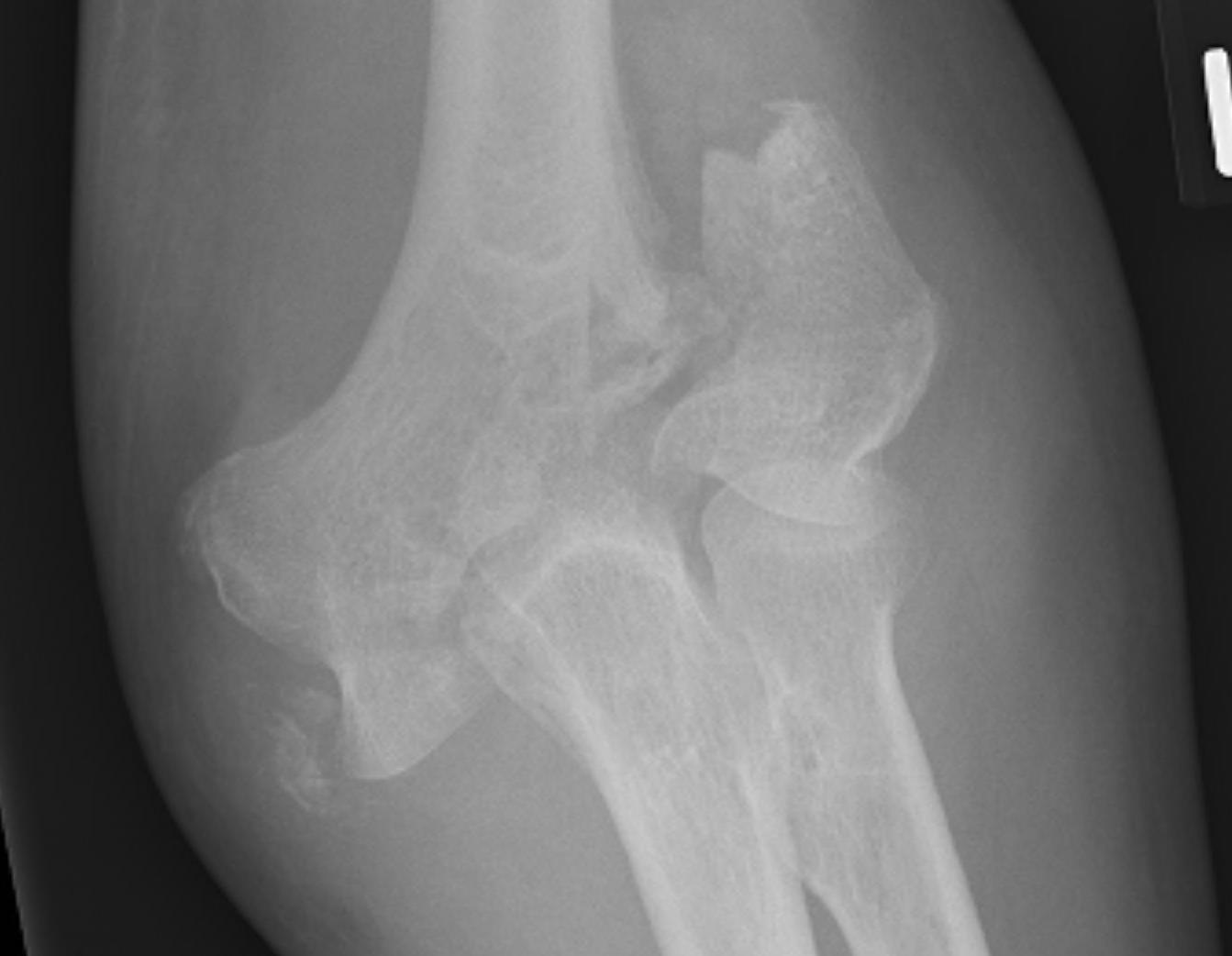 Elbow Lateral Condyle Fracture